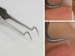 Stainless Steel Blackhead Remover Extractor Tool