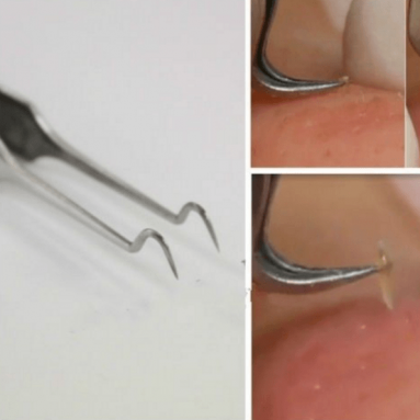 Stainless Steel Blackhead Remover Extractor Tool